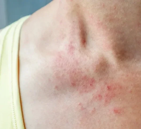 Kuş Biti Isırdıysa Ne Yapılmalı? Belirtileri ve İlk Müdahale